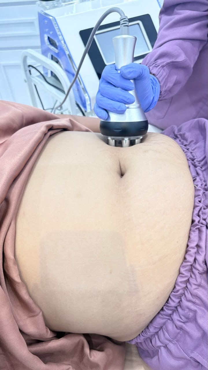 Sebelum - Radio Frequency Treatment